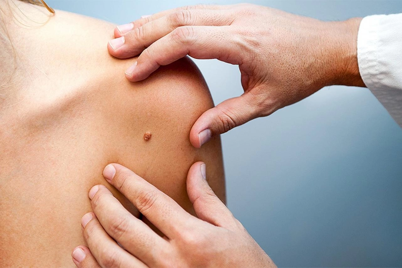 Ljeta postaju nepredvidiva, toplija i opasnija, posebno za one sa melanomima (video)
